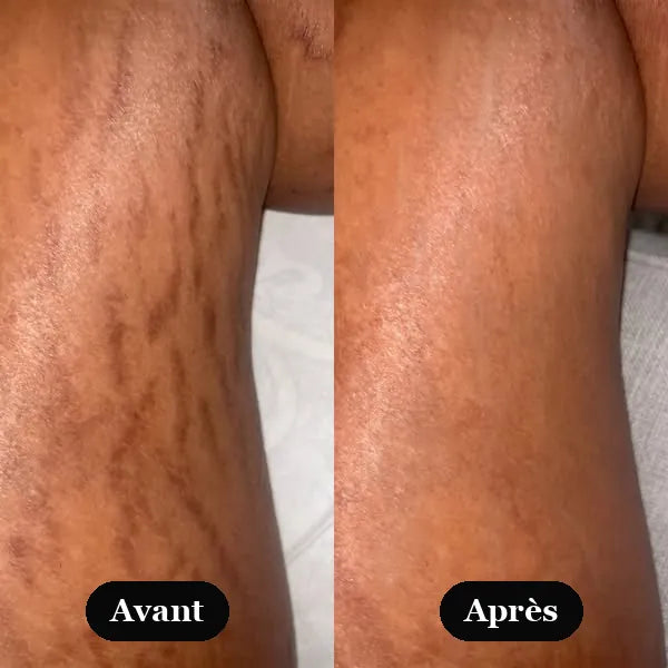 Avant / Après — résultats Sérum Rétinal Kaya's Beauty, jambe