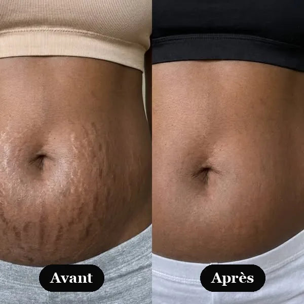 Avant / Après — résultats Sérum Rétinal Kaya's Beauty, ventre