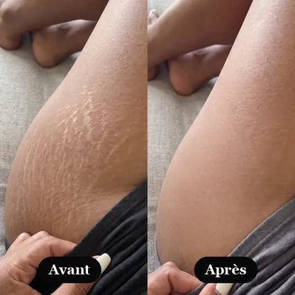 Avant / Après — résultats Sérum Rétinal Kaya's Beauty, cuisse