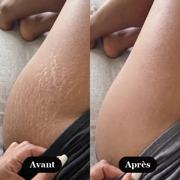 Cuisse