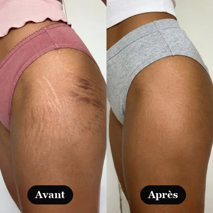 Avant / Après — résultats Sérum Rétinal Kaya's Beauty, fesses et cuisses
